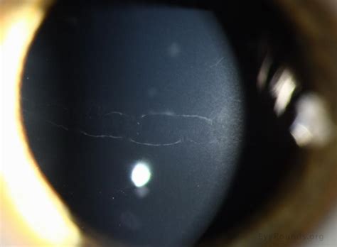 Posterior Polymorphous Corneal Dystrophy Ppmd
