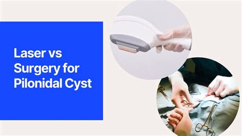 Laser Vs Surgery For Pilonidal Cysts