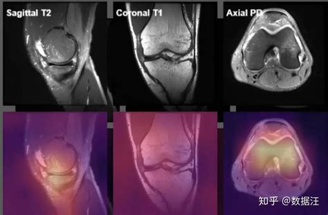 吴恩达团队最新：利用mrnet进行膝关节磁共振成像辅助诊断 知乎