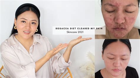 Rosacea Diet⎜foods To Avoid And Include To Clear Rosacea Youtube