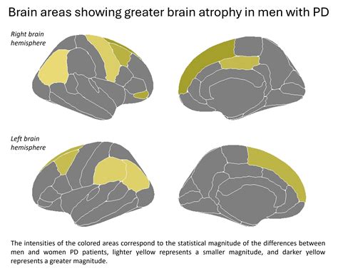 Parkinsons Disease Impacts The Brain Differently Depending On Sex Research Communities By