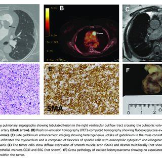 Multimodal Imaging And Pathology Of Right Ventricular Outflow Tract