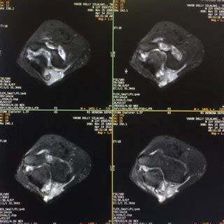 Gambar 1. Hasil Gambaran MRI Elbow Joint Sequence AX T2 FS | Download ...