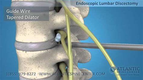 Lumbar Endoscopic Discectomy Surgery And Cervical Spine Atlantic