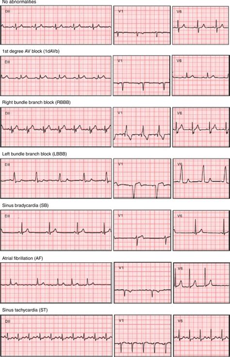 New Ai Tool For Cardiac Diagnostics • Healthcare In