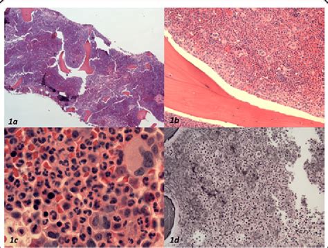 Bone Marrow Core Biopsy A Low Power View 4x Hande Showing High