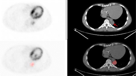 Axial ¹⁸F FDG PET and CT scans The tumour is indicated by the arrow