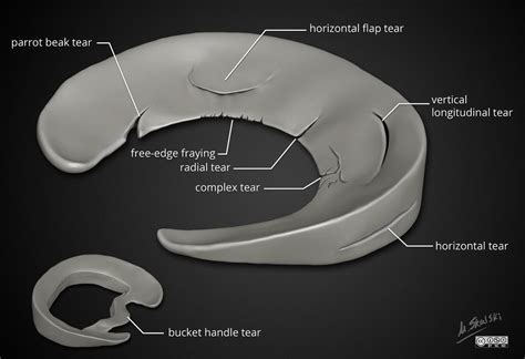 Meniscal Tear Causes, Presentation and Treatment | Bone and Spine