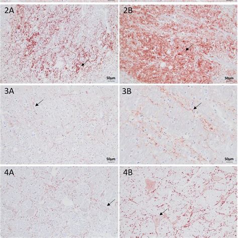 Intracellular PrP Sc Accumulation In Brain Sections Of Moose With CWD