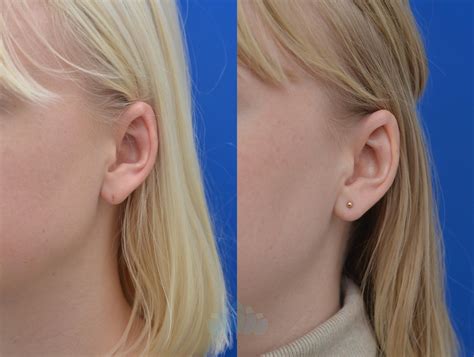 Otoplasty Earlobe Repair For Charlotte Concord Nc Dilworth