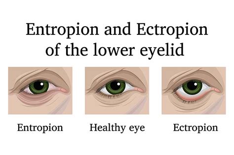 Entropion Types Definition Surgery Treatment 41 Off