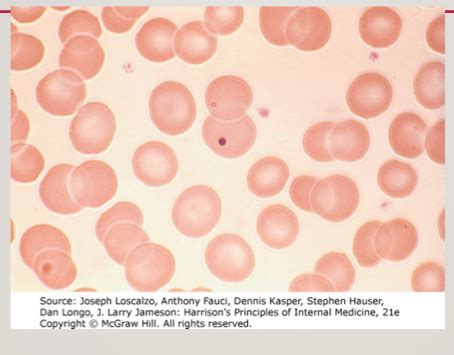 Hemolytic Anemias Flashcards Quizlet