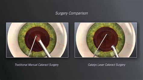 Catalys Laser Cataract Surgery Vs Traditional Manual Cataract Surgery Animation Youtube