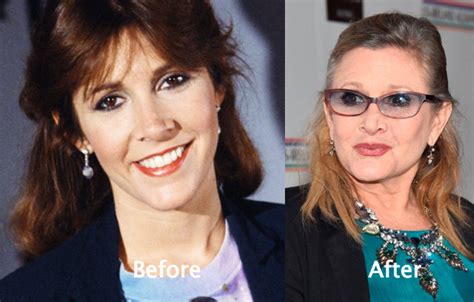 Carrie Fisher Plastic Surgery Before and After Photos