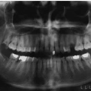 Floor Of The Nasal Cavity Radiograph