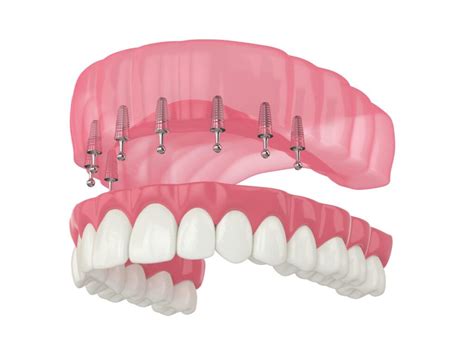 Snap In Dentures A Comprehensive Guide To Implant Retained Dentures