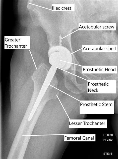 Minimally Invasive Total Hip Replacement Complete Orthopedics