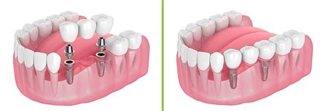 Implant-Supported Dental Bridges, Gosford: VC Dental