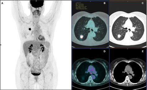 ¹⁸F FDG PET CT maximum intensity projection A transaxial fused B