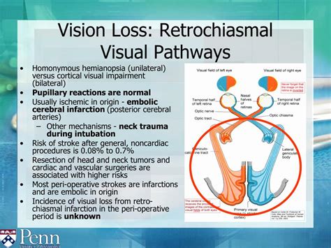 Ppt Perioperative Visual Loss Powerpoint Presentation Free Download