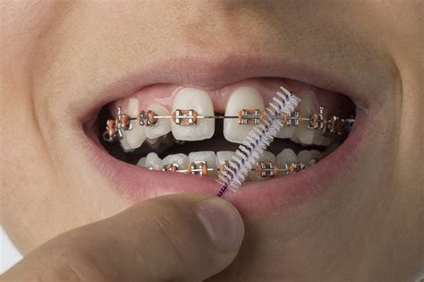 Cavities Caused By Braces 3 Bracket Problems And Solutions