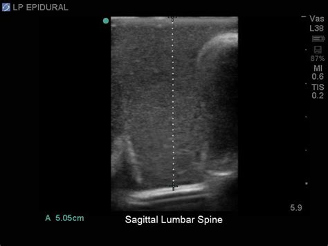 Blue Phantom™ Spinal Epidural Lumbar Puncture And Cervical Epidural