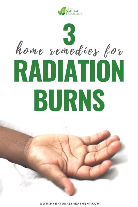 3 Home Remedies For Radiation Burns Radiation Burn Home Remedies