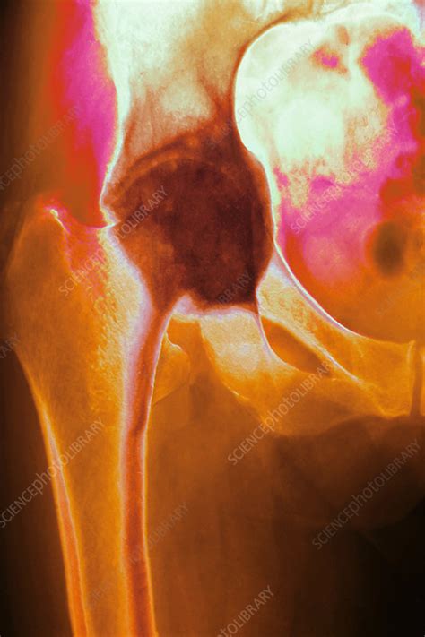 Arthritic Hip X Ray Stock Image M1100602 Science Photo Library