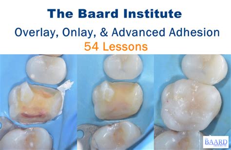 Overlay Onlay And Advanced Adhesion Dental Videos