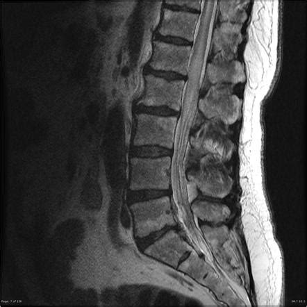 Spinal Cord Astrocytoma Conus Radiology Case Radiopaedia Org