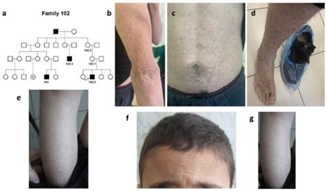 Ijms Free Full Text Genetic Heterogeneity Of X Linked Ichthyosis In