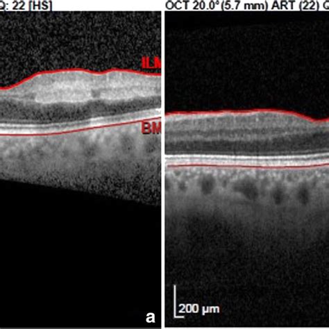 Spectral Domain Optical Coherence Tomography Sd Oct Spectralis