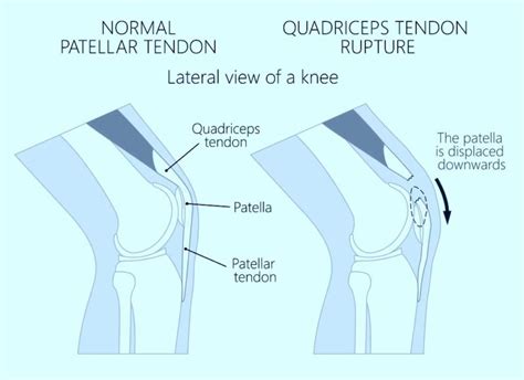 Knee Treatments Archives Benedict Nwachukwu Md Mba Hip Knee