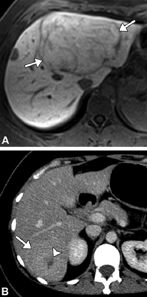 Hepatocellular Adenoma Hca Mimicking Fnh A Axial Hbp Mr Image