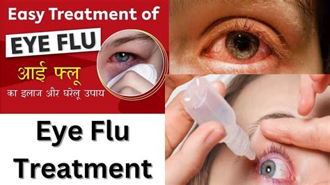 Clear Vision Effective Eye Flu Treatment For Rapid Relief Eye Flu Treatment By Bhartirahul