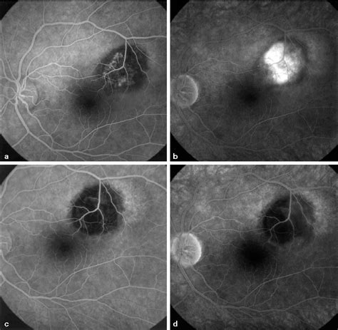 Figure From Subretinal Choroidal Neovascularization Associated With