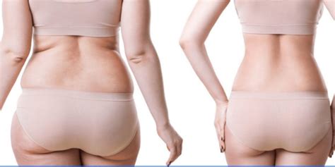 Pros And Cons Of Weight Loss Surgery Asli Tarcan Clinic