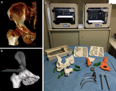 Planificaci N Quir Rgica De Osteosarcoma P Lvico Resecci N Y