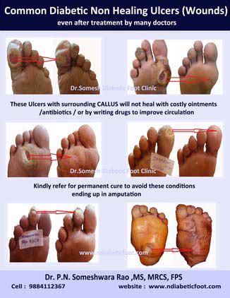 [36+] Writers Callus Treatment