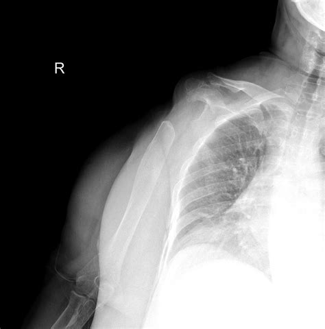 Postoperative Anteroposterior Direct Radiography Of Affected Shoulder