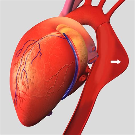 Thoracic Aortic Aneurysm Sydney | Endovascular Aneurysm Repair Sydney