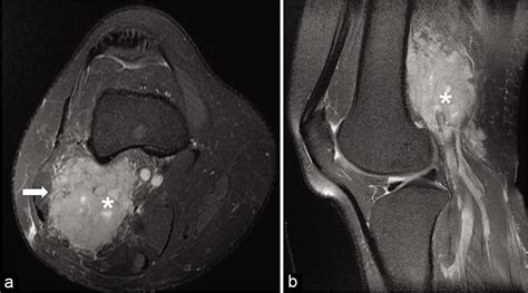 Glomus Tumor Radiology