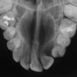 Maxillary Occlusal Radiograph Shows A Horizontally Impacted Upper Right