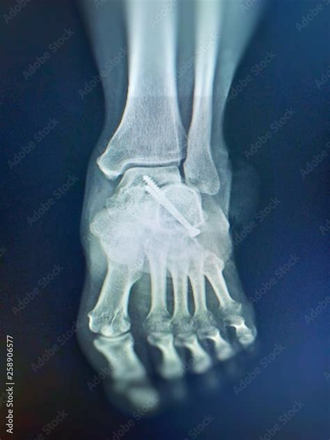 Ankle joint x-ray AP view Post subtalar joint arthrodesis with two ...