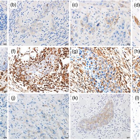 Immunostaining Of N‐cadherin Vimentin And E‐cadherin In Squamous Cell Download Scientific