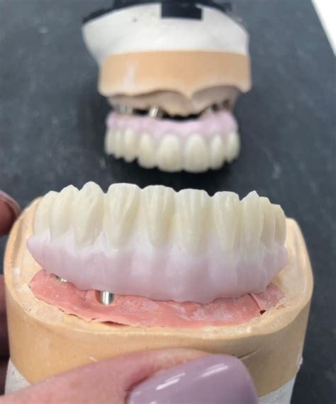 Case With Our Tibase Dynamic Abutment Solutions EN