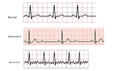 Schemes Set Of Common Electrocardiogram Ecg 49 Off