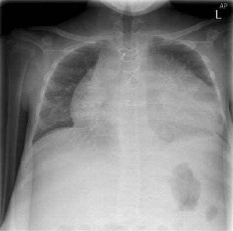 Chest X Ray Showing An Enlarged Heart Due To Ebsteins Anomaly