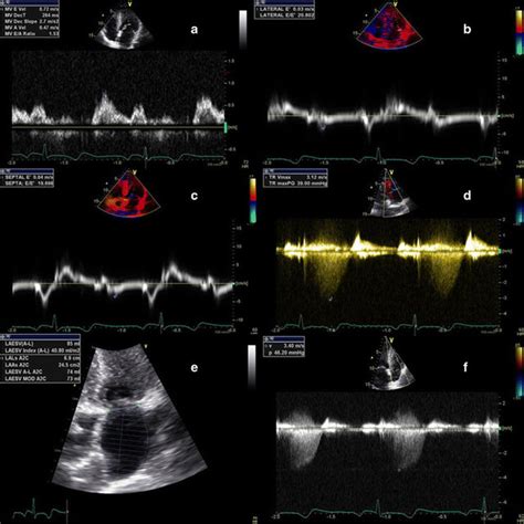 Algorithm for diagnosis of LV diastolic dysfunction in subjects with ...