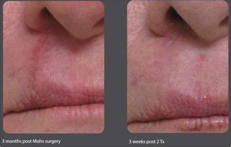 Before And After Mohs Surgery Upper Lip Infoupdate Org